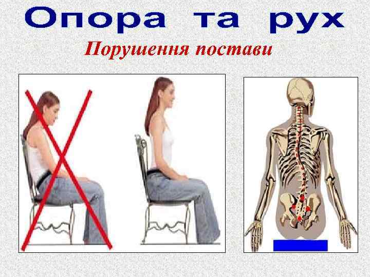 Порушення постави 