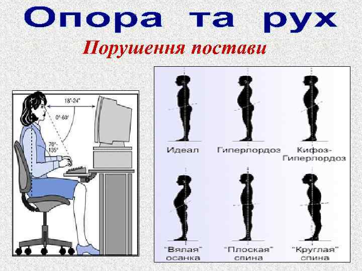 Порушення постави 