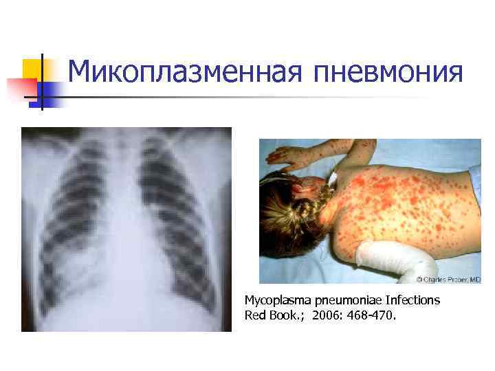 Микоплазменная пневмония Mycoplasma pneumoniae Infections Red Book. ; 2006: 468 -470. 