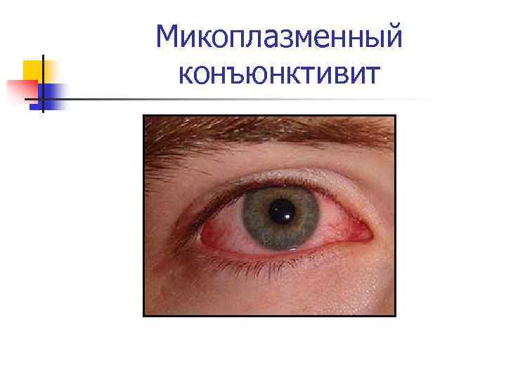 Микоплазменный конъюнктивит 