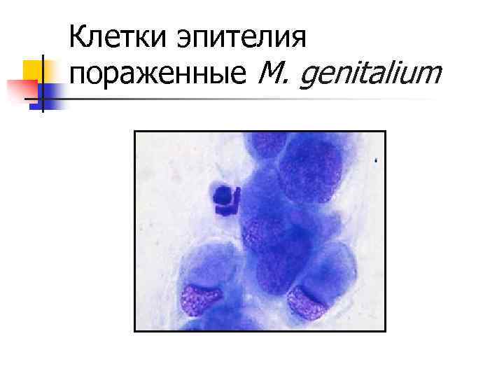 Клетки эпителия пораженные M. genitalium 