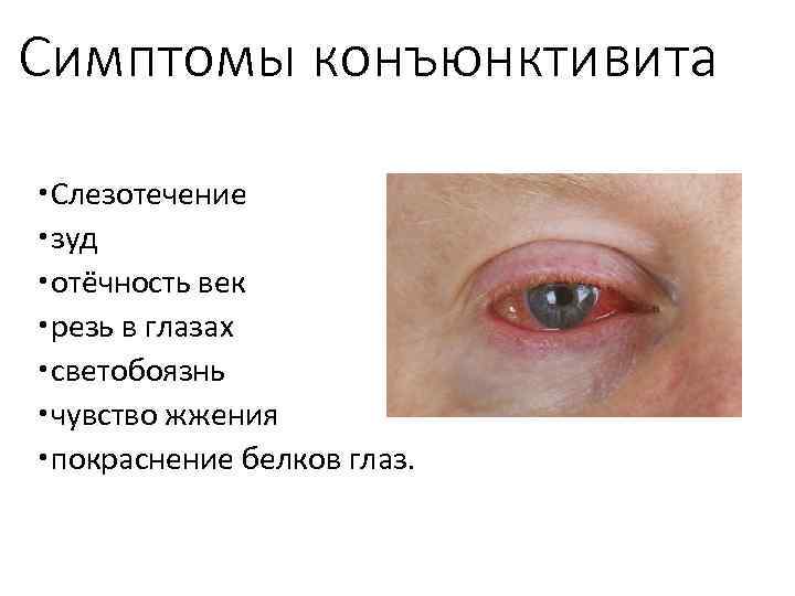 Симптомы конъюнктивита Слезотечение зуд отёчность век резь в глазах светобоязнь чувство жжения покраснение белков