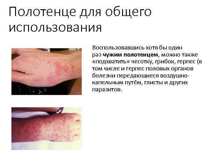 Полотенце для общего использования Воспользовавшись хотя бы один раз чужим полотенцем, можно также «подхватить»