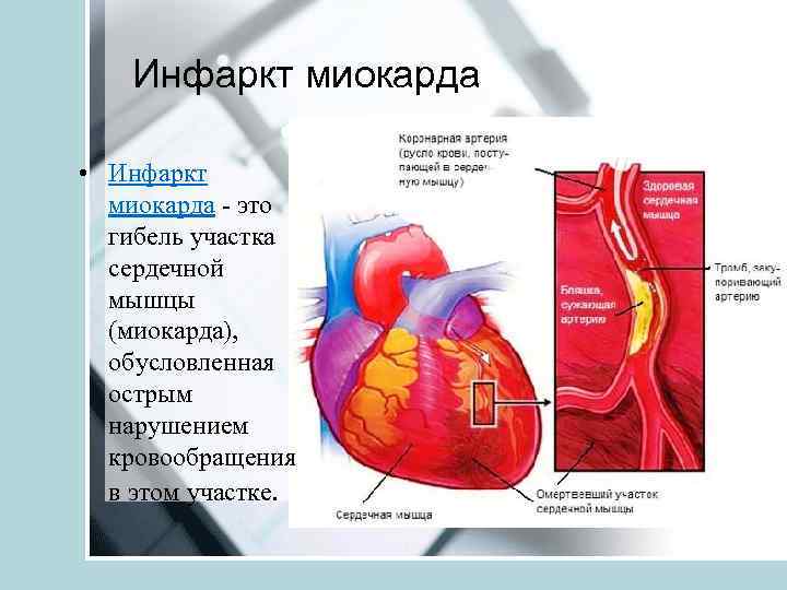 Инфаркт миокарда • Инфаркт миокарда - это гибель участка сердечной мышцы (миокарда), обусловленная острым