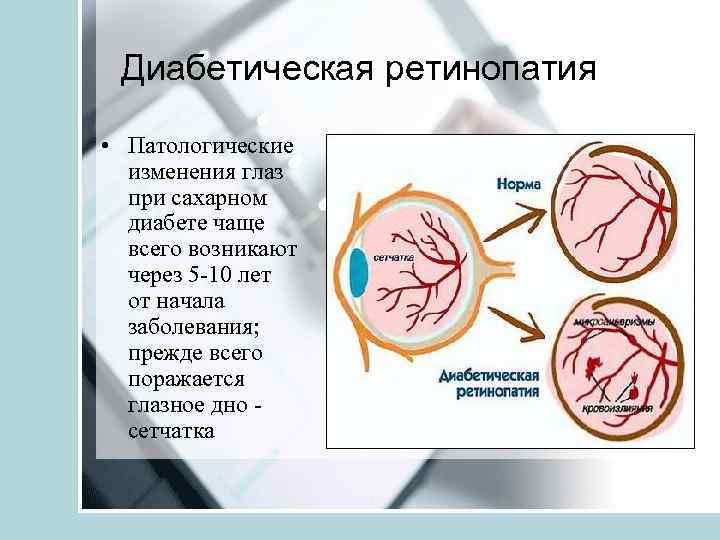 Диабетическая ретинопатия • Патологические изменения глаз при сахарном диабете чаще всего возникают через 5