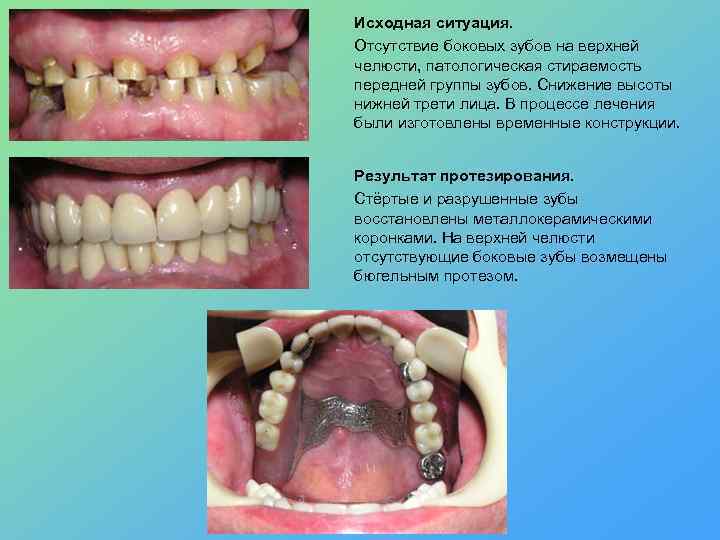 Исходная ситуация. Отсутствие боковых зубов на верхней челюсти, патологическая стираемость передней группы зубов. Снижение