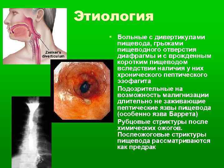 Этиология Больные с дивертикулами пищевода, грыжами пищеводного отверстия диафрагмы и с врожденным коротким пищеводом