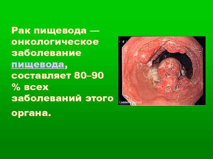 Рак пищевода — онкологическое заболевание пищевода, составляет 80– 90 % всех заболеваний этого органа.