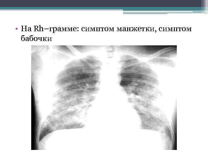  • На Rh–грамме: симптом манжетки, симптом бабочки 