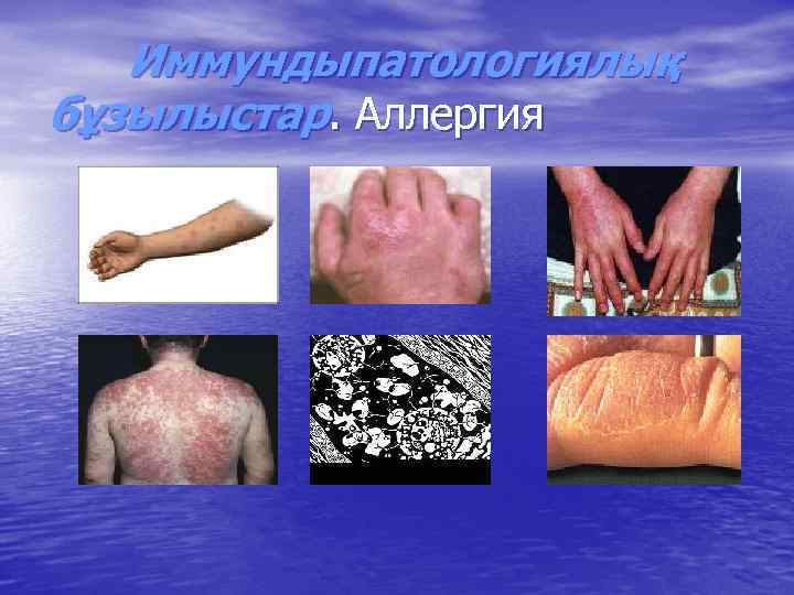 Иммундыпатологиялық бұзылыстар. Аллергия 