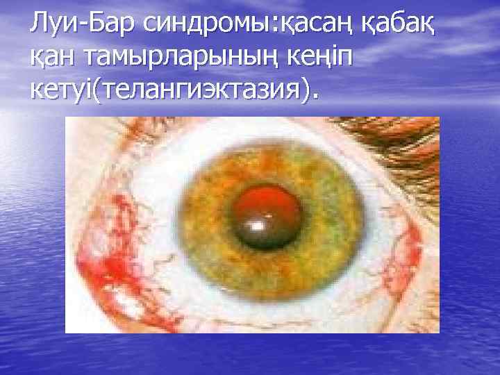 Луи-Бар синдромы: қасаң қабақ қан тамырларының кеңіп кетуі(телангиэктазия). 