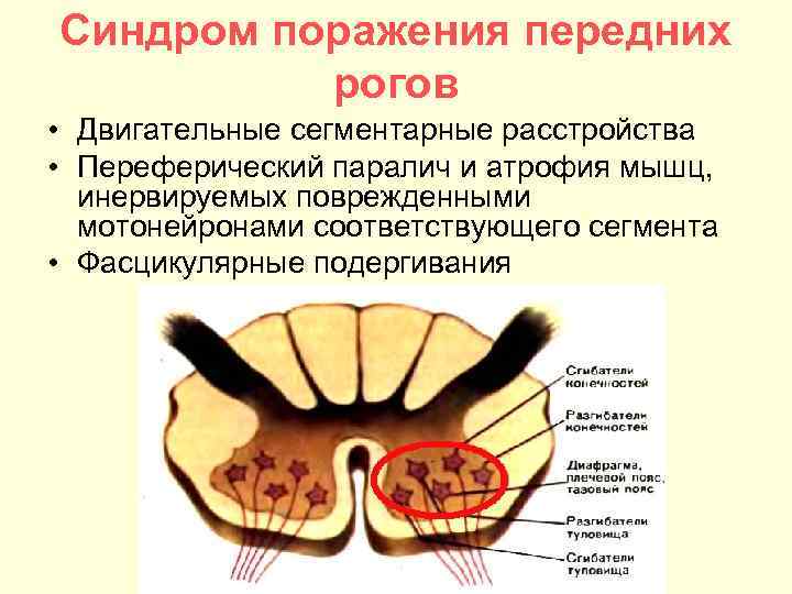 Синдром поражения передних рогов • Двигательные сегментарные расстройства • Переферический паралич и атрофия мышц,