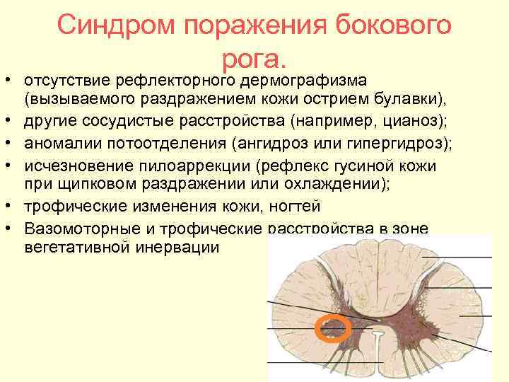 Синдром поражения бокового рога. • отсутствие рефлекторного дермографизма (вызываемого раздражением кожи острием булавки), •