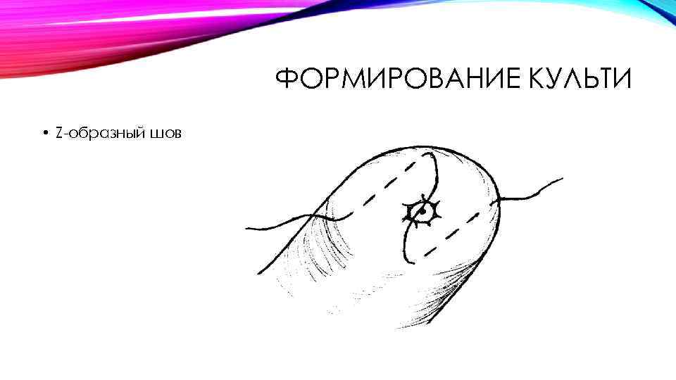 ФОРМИРОВАНИЕ КУЛЬТИ • Z-образный шов 