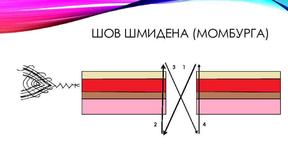 ШОВ ШМИДЕНА (МОМБУРГА) 3 2 1 4 