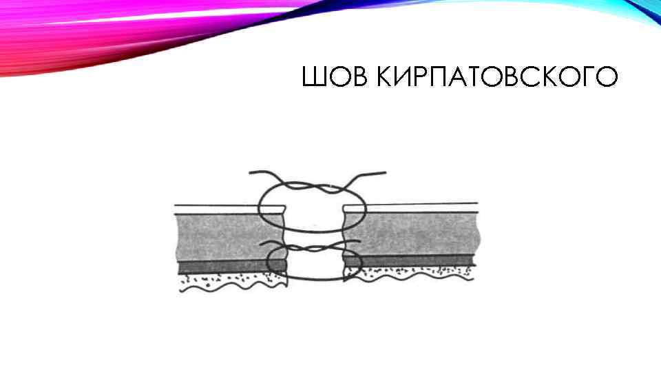 ШОВ КИРПАТОВСКОГО 