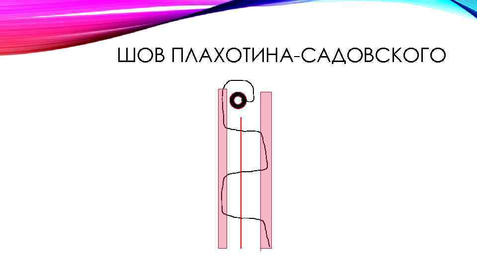 ШОВ ПЛАХОТИНА-САДОВСКОГО 