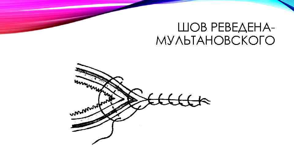 ШОВ РЕВЕДЕНАМУЛЬТАНОВСКОГО 