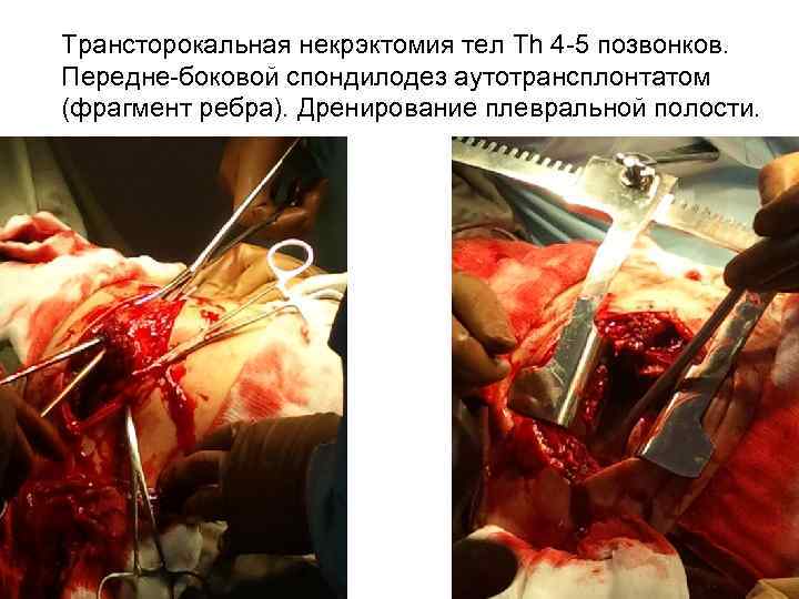 Трансторокальная некрэктомия тел Th 4 -5 позвонков. Передне-боковой спондилодез аутотрансплонтатом (фрагмент ребра). Дренирование плевральной