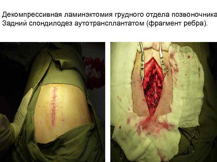 Декомпрессивная ламинэктомия грудного отдела позвоночника Задний спондилодез аутотрансплантатом (фрагмент ребра). 