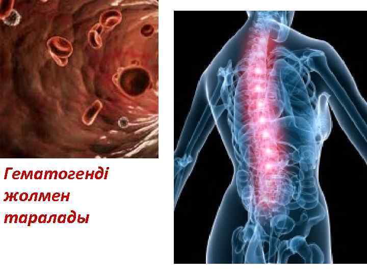 Гематогенді жолмен таралады 