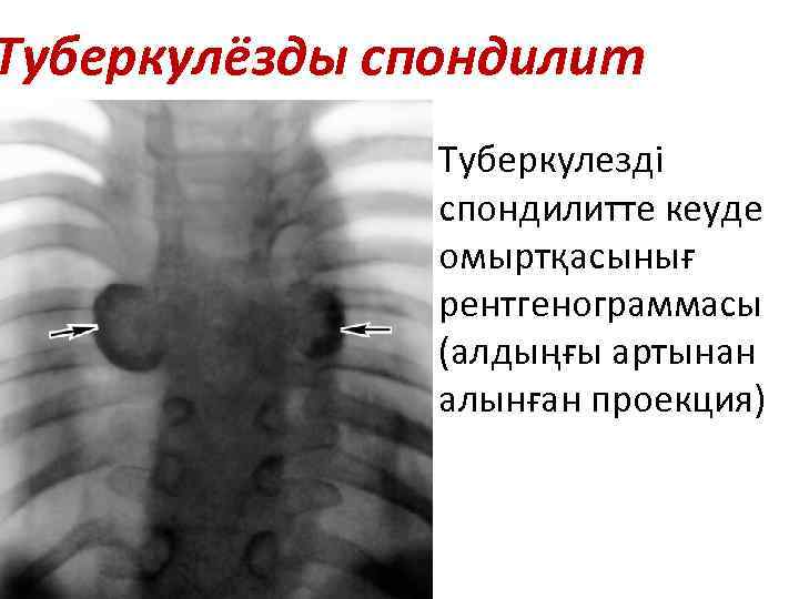 Туберкулёзды спондилит Туберкулезді спондилитте кеуде омыртқасынығ рентгенограммасы (алдыңғы артынан алынған проекция) 