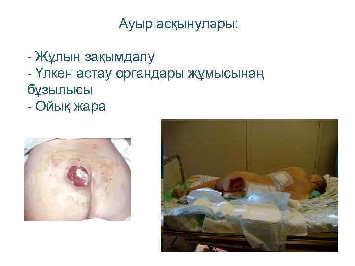 Ауыр асқынулары: - Жұлын зақымдалу - Үлкен астау органдары жұмысынаң бұзылысы - Ойық жара