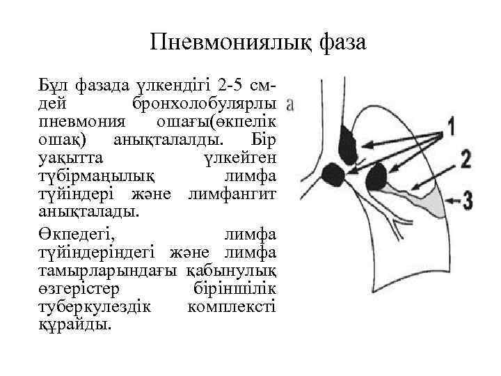 Пневмониялық фаза Бұл фазада үлкендігі 2 -5 смдей бронхолобулярлы пневмония ошағы(өкпелік ошақ) анықталалды. Бір