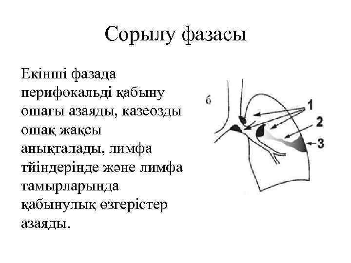 Сорылу фазасы Екінші фазада перифокальді қабыну ошагы азаяды, казеозды ошақ жақсы анықталады, лимфа тйіндерінде