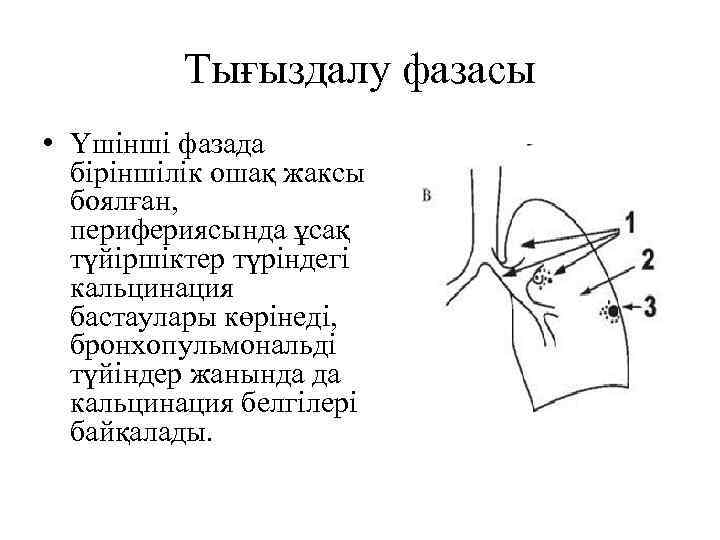 Тығыздалу фазасы • Үшінші фазада біріншілік ошақ жаксы боялған, перифериясында ұсақ түйіршіктер түріндегі кальцинация