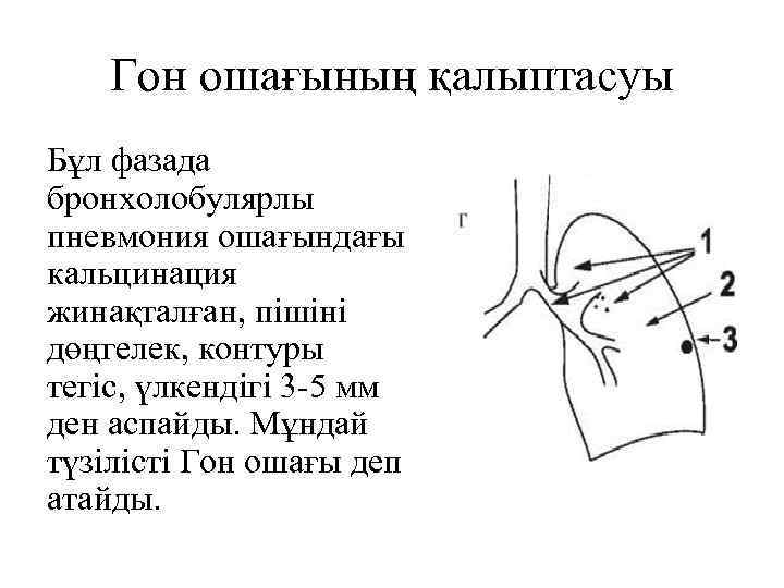 Гон ошағының қалыптасуы Бұл фазада бронхолобулярлы пневмония ошағындағы кальцинация жинақталған, пішіні дөңгелек, контуры тегіс,