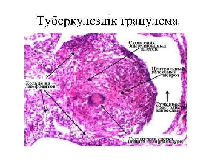 Туберкулездік гранулема 