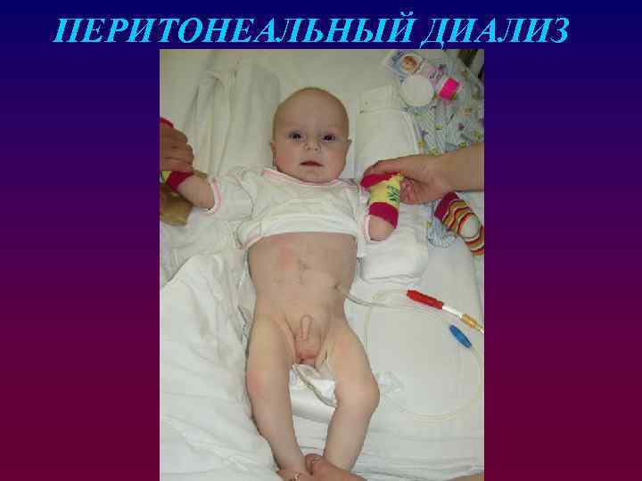 ПЕРИТОНЕАЛЬНЫЙ ДИАЛИЗ 