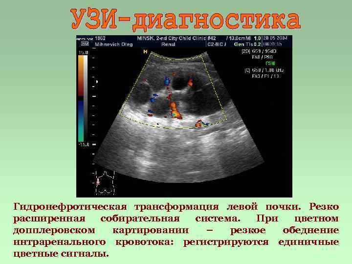 Гидронефротическая трансформация левой почки. Резко расширенная собирательная система. При цветном допплеровском картировании – резкое