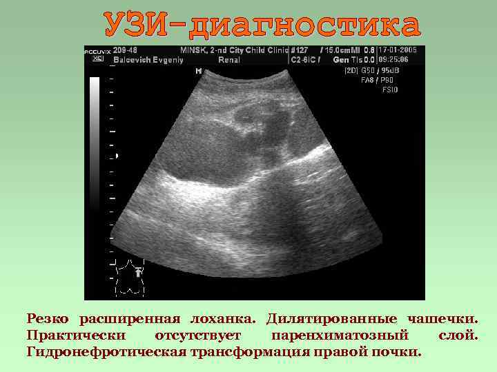 Резко расширенная лоханка. Дилятированные чашечки. Практически отсутствует паренхиматозный слой. Гидронефротическая трансформация правой почки. 