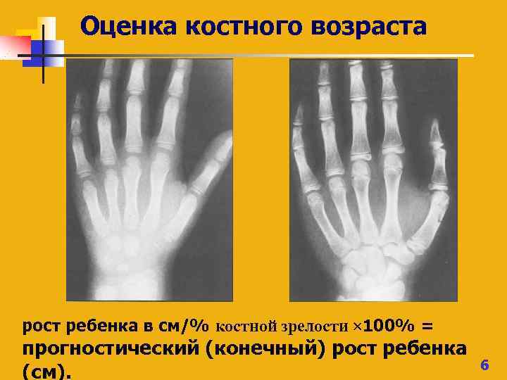 Костный возраст. Зоны роста у детей по возрастам. Оценка костного возраста у детей. Зоны роста кисти у детей. Отставание костного возраста у ребенка.