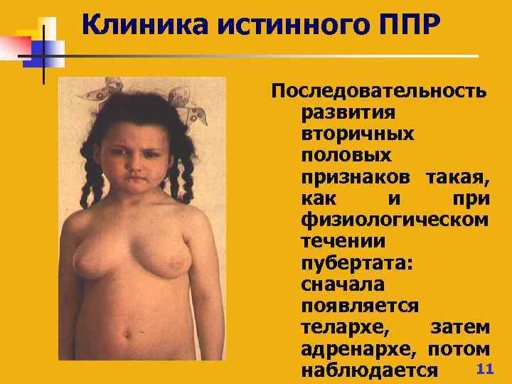 Клиника истинного ППР Последовательность развития вторичных половых признаков такая, как и при физиологическом течении