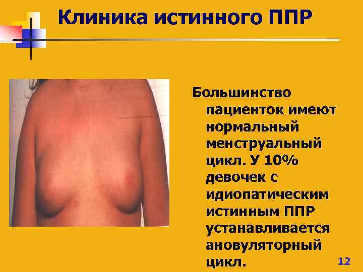 Клиника истинного ППР Большинство пациенток имеют нормальный менструальный цикл. У 10% девочек с идиопатическим