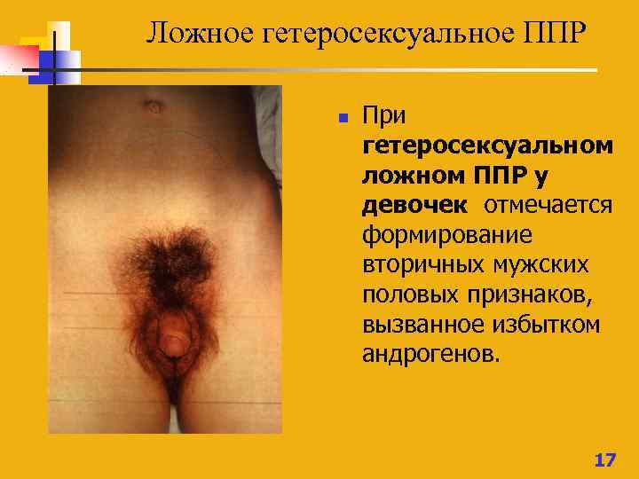Ложное гетеросексуальное ППР n При гетеросексуальном ложном ППР у девочек отмечается формирование вторичных мужских