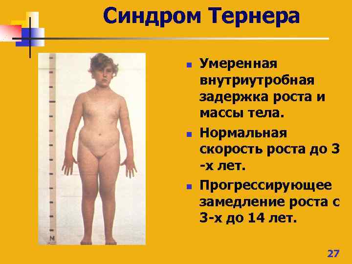 Синдром Тернера n n n Умеренная внутриутробная задержка роста и массы тела. Нормальная скорость