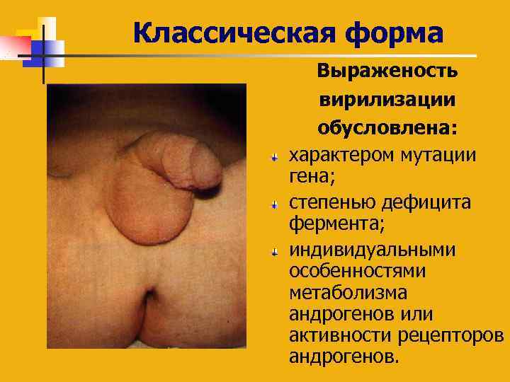 Классическая форма Выраженость вирилизации обусловлена: характером мутации гена; степенью дефицита фермента; индивидуальными особенностями метаболизма