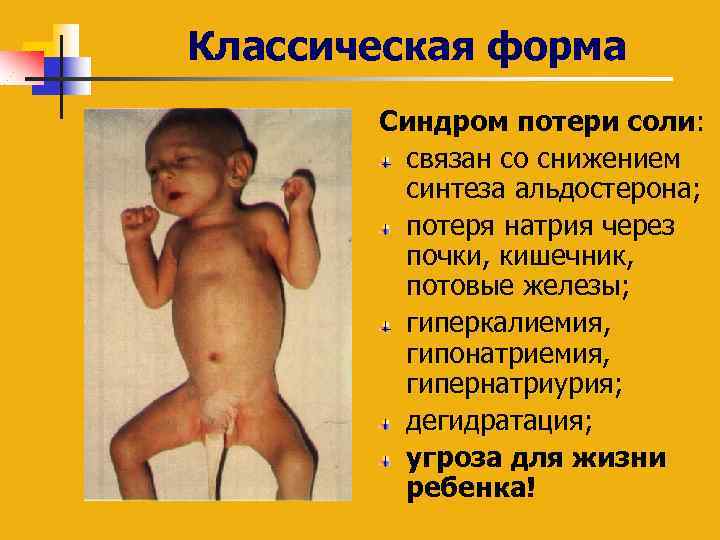 Классическая форма Синдром потери соли: cвязан со снижением синтеза альдостерона; потеря натрия через почки,