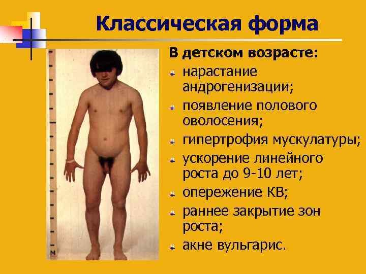 Классическая форма В детском возрасте: нарастание андрогенизации; появление полового оволосения; гипертрофия мускулатуры; ускорение линейного
