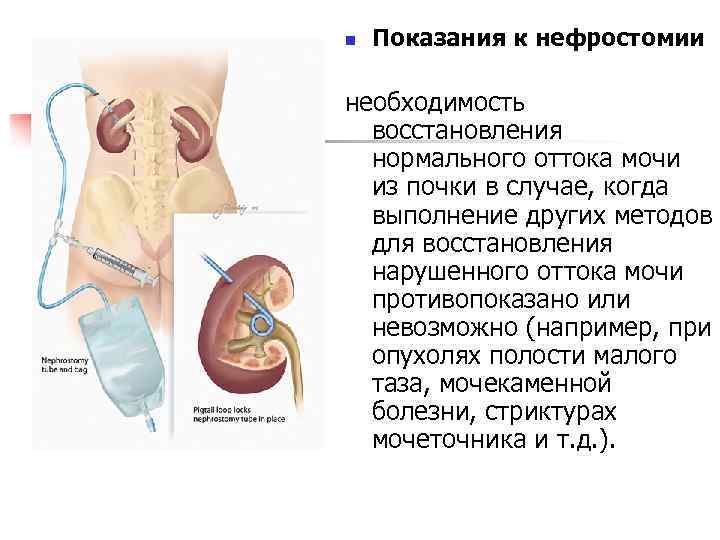 n Показания к нефростомии необходимость восстановления нормального оттока мочи из почки в случае, когда