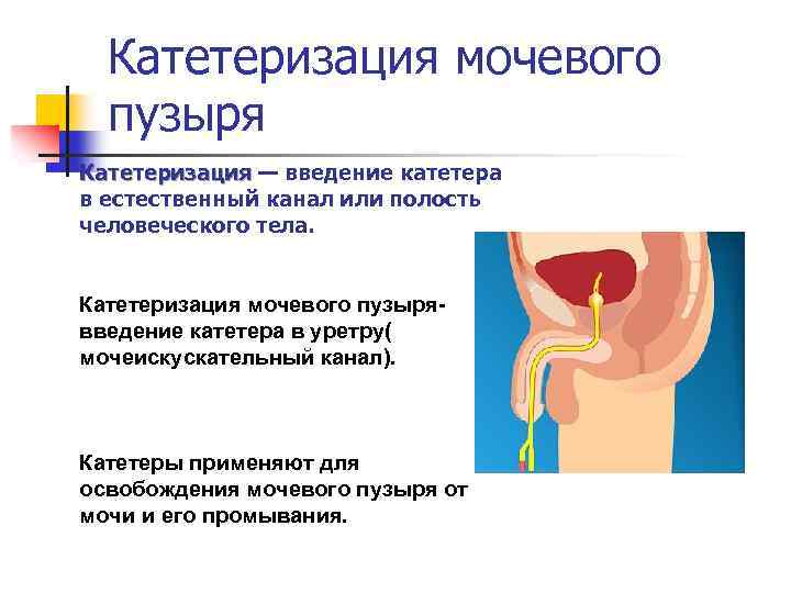 Катетеризация мочевого пузыря Катетеризация — введение катетера Катетеризация в естественный канал или полость человеческого