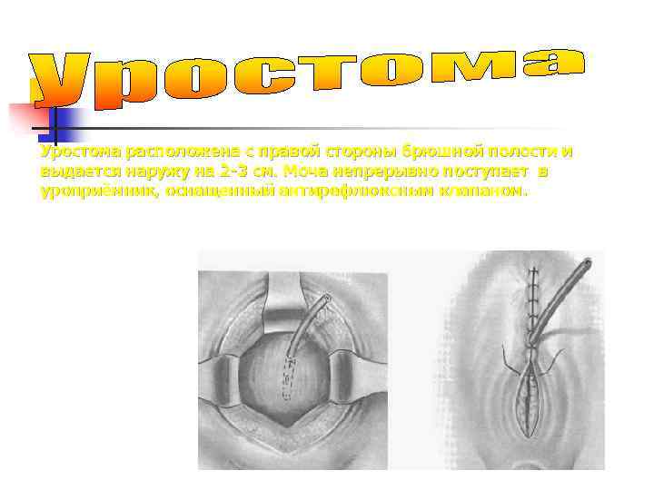 Уростома расположена с правой стороны брюшной полости и выдается наружу на 2 -3 см.