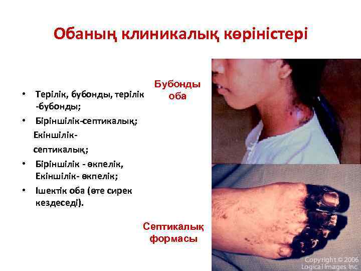 Обаның клиникалық көріністері • Терілік, бубонды, терілік -бубонды; • Біріншілік-септикалық; Екіншіліксептикалық; • Біріншілік -