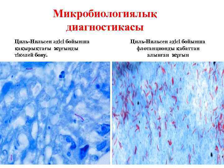 Микробиологиялық диагностикасы Циль-Нильсен әдісі бойынша қақырықтағы жұғынды тікелей бояу. Циль-Нильсен әдісі бойынша флотанционды қабаттан