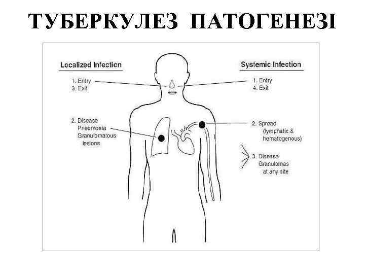 ТУБЕРКУЛЕЗ ПАТОГЕНЕЗІ 