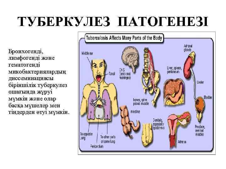 ТУБЕРКУЛЕЗ ПАТОГЕНЕЗІ Бронхогенді, лимфогенді және гематогенді микобактериялардың диссеминациясы біріншілік туберкулез ошағында жүруі мүмкін және